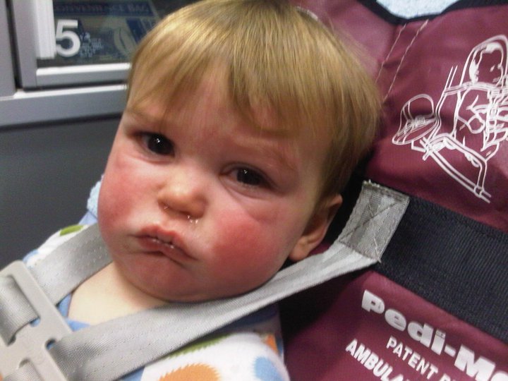 Mason at 14 months being rushed to hospital after a reaction to tilapia.